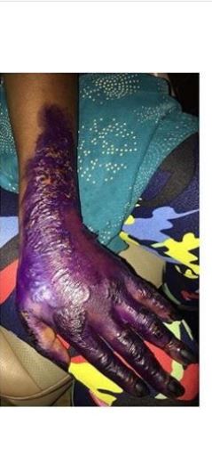 Lady Gets Henna On Her Hand, Few Weeks Later See What Has Happened To It (Photos)